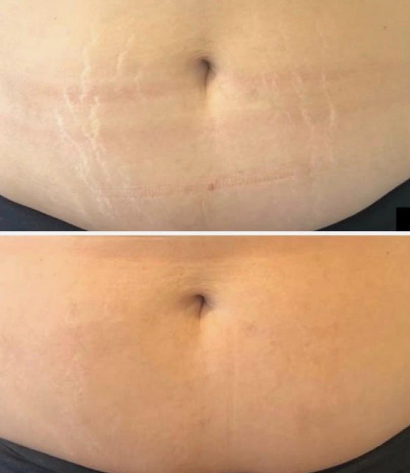 Antes e depois — camuflagem de cicatriz abdominal